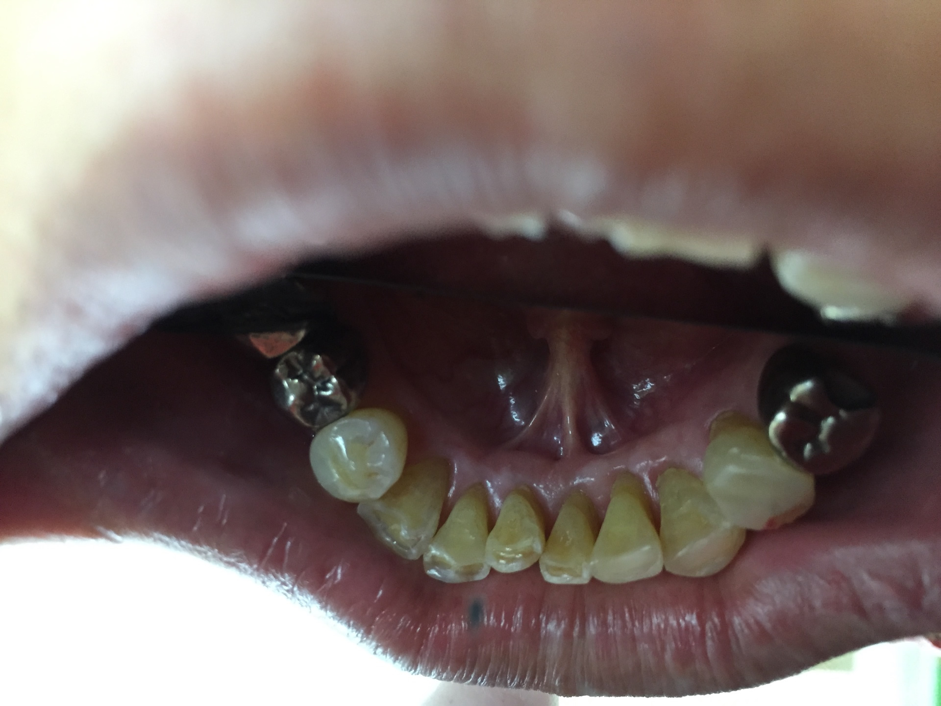酸蝕症 下の歯